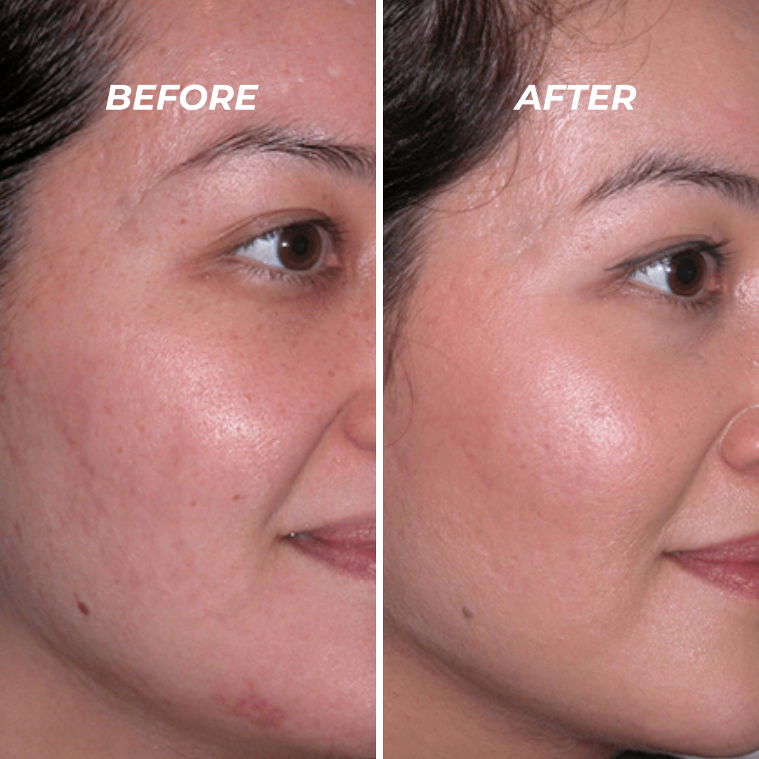 Microdermabrasion and Mini Cool with Yeast Extract